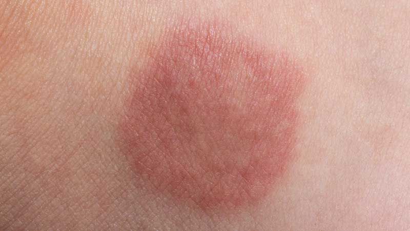 Jock Itch Cream and Treatments