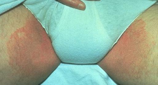 Jock Itch Cream and Treatments